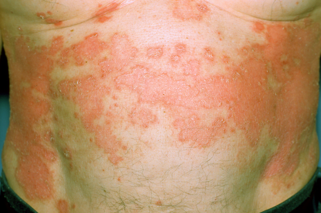  PsAに最適な鎮痛剤は何ですか?